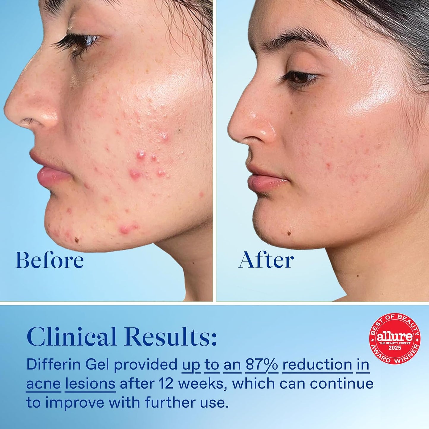 clinically validated: up to 87% acne reduction in 12 weeks (cunliffe et al 1998)