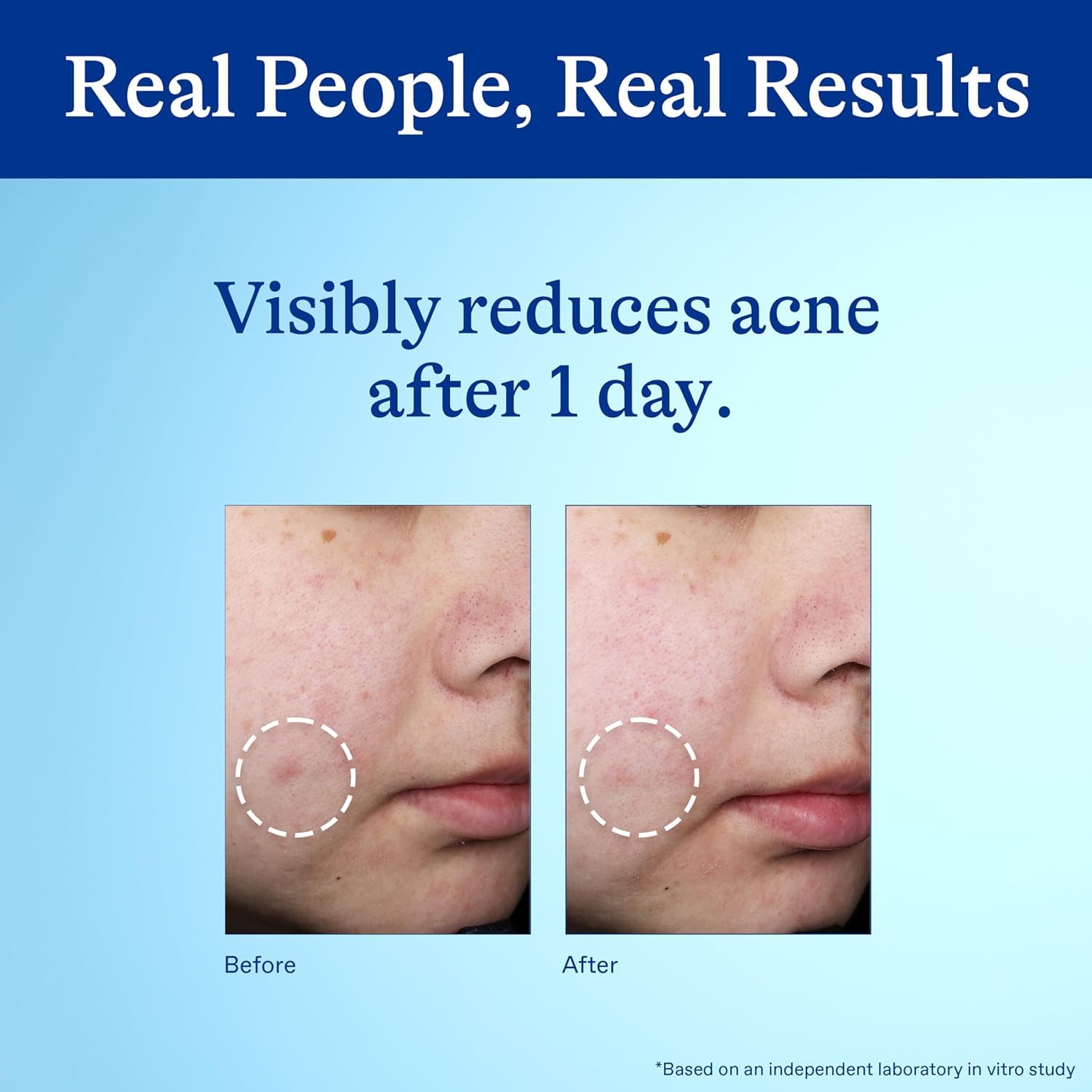 Differin 10% Benzoyl Peroxide Spot Treatment – Family Bathroom Essential for Teen Acne, 1 oz Gel