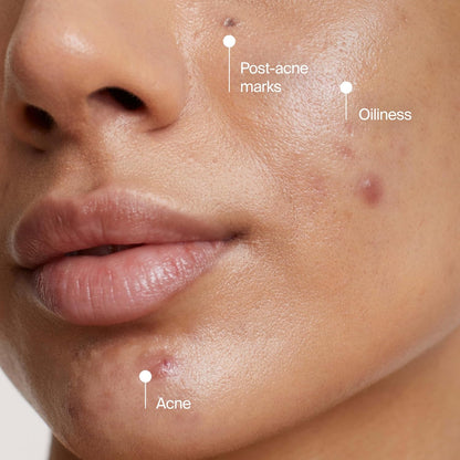 Neutrogena Evenly Clear Benzoyl Peroxide Clay Mask – One-Tube Simplicity for Effortless Acne Care Routines